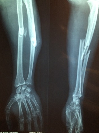 fracture-bone-2333164_1920